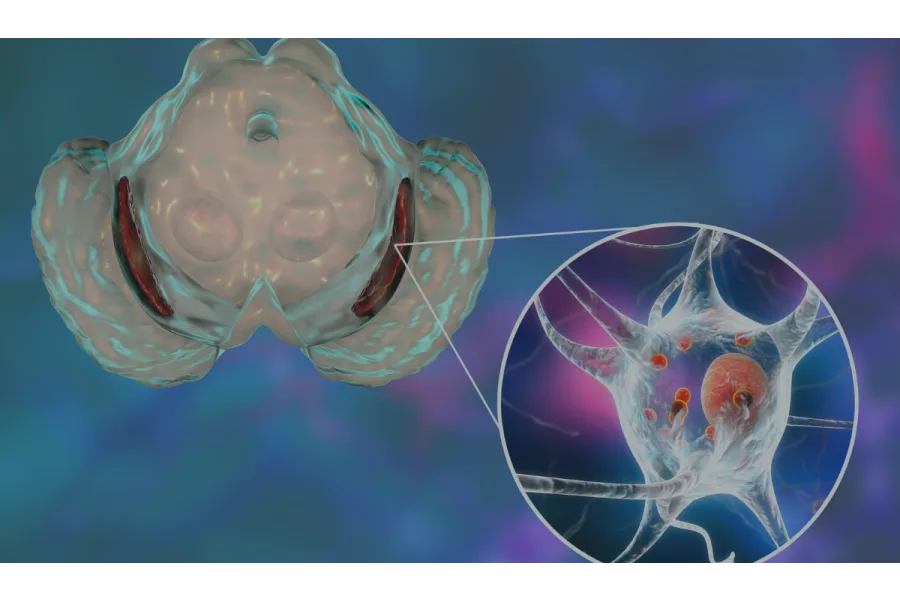 Parkinson’s and Medical Marijuana